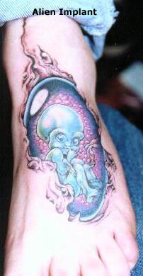 alianimplant.JPG (24541 bytes)